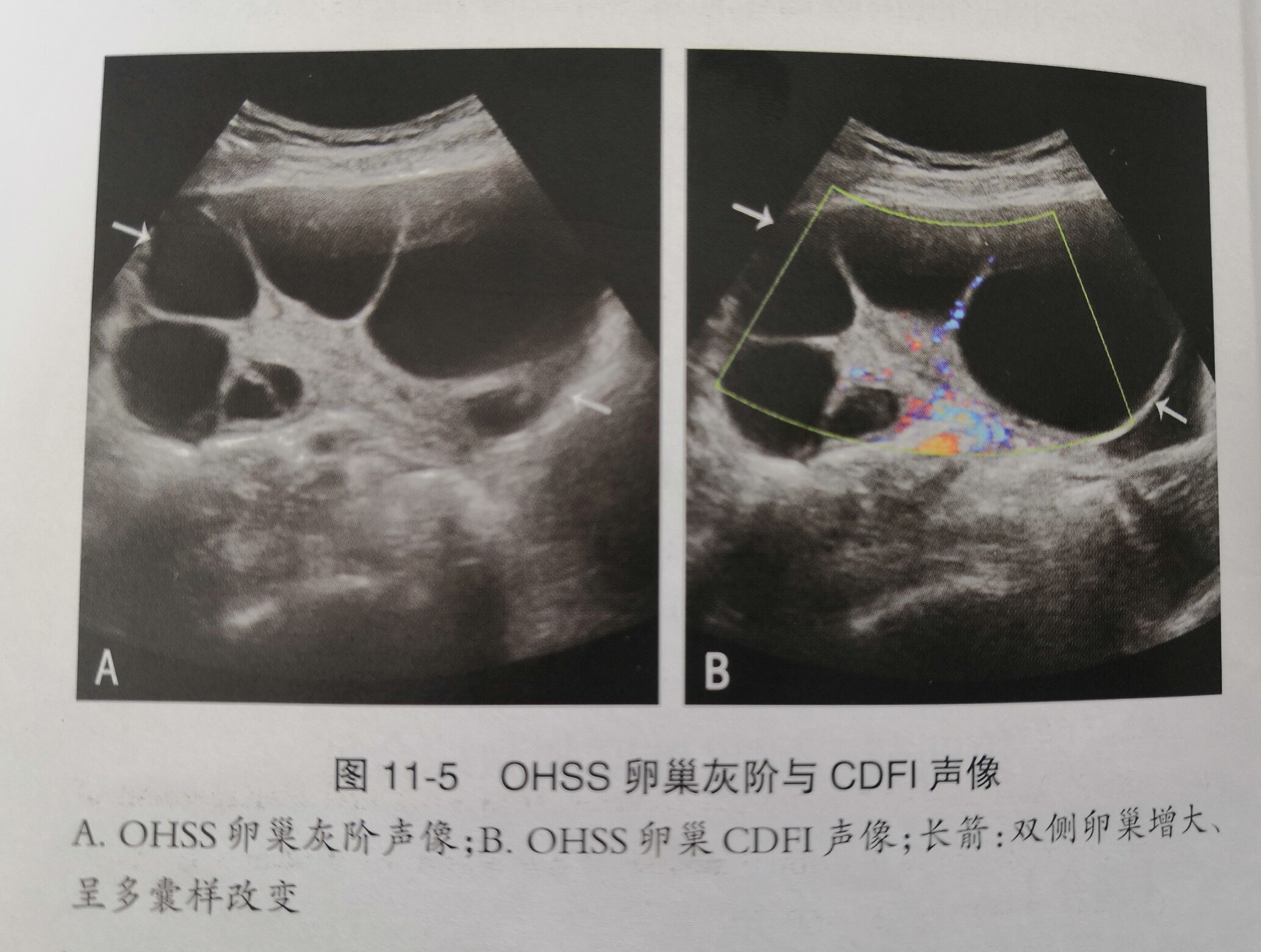 卵巢过度刺激综合征 妇科病