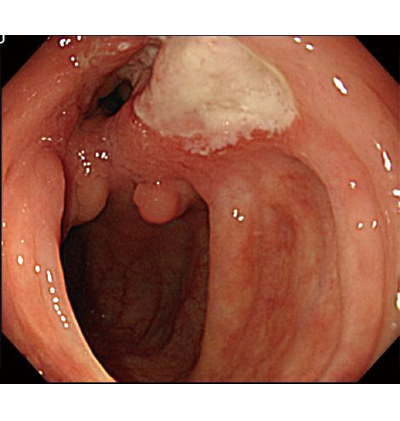 (4)	血管病変 8%以血管病变为主的又称为血管白塞(vascular-bd),主要