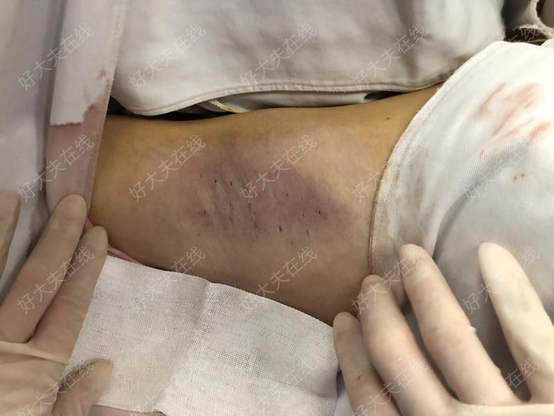 腋臭_腋臭 - 好大夫在线