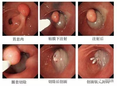 哪些胃息肉必须要手术 胃息肉