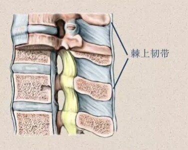 棘间韧带炎位置图图片