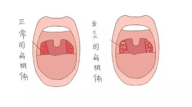 腺样体与扁桃体 一对难兄难弟_小儿腺样体肥大_介绍_治疗方式 - 好