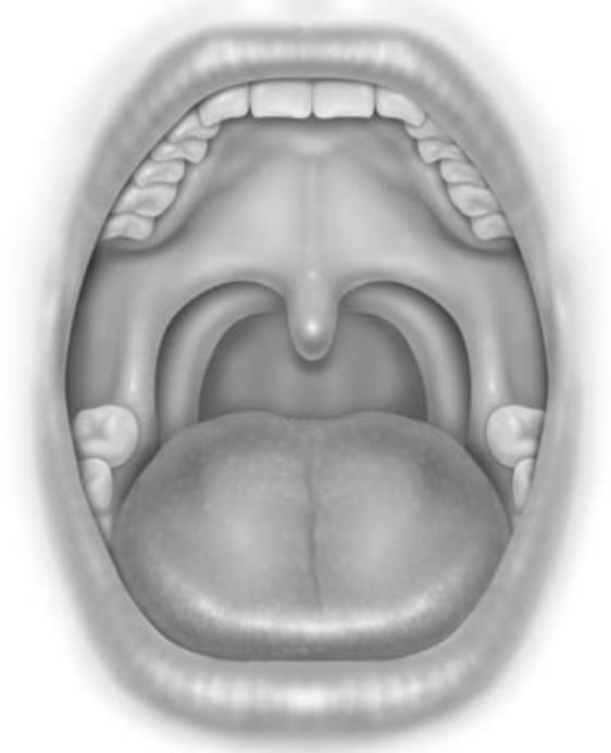 正常软腭和悬雍垂腭咽弓宽,与悬雍垂顶部相连,口咽明显狭窄2,3治疗咽