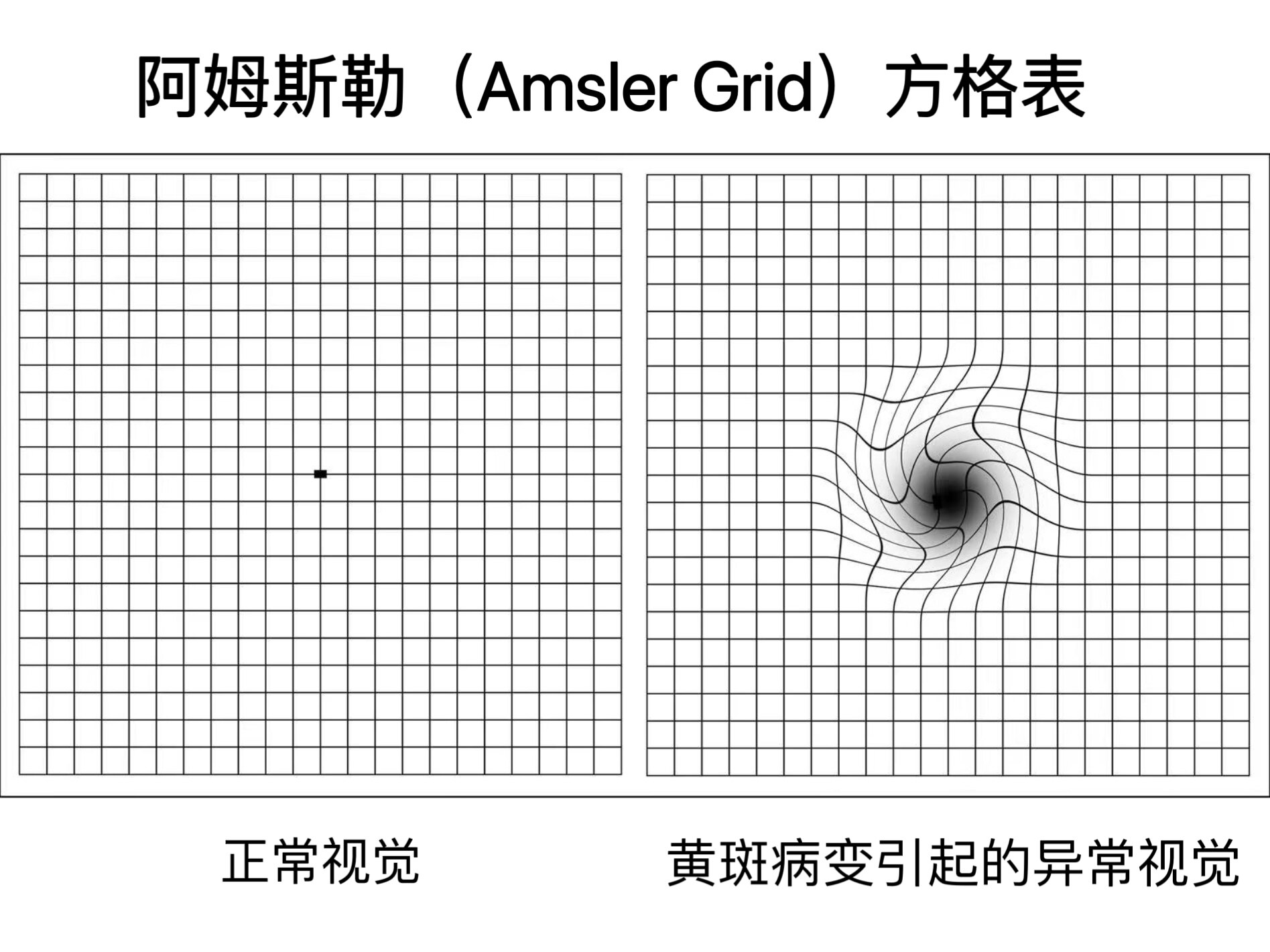 视物变形——警惕眼底黄斑变性!_黄斑变性_介绍_症状表现_检查 - 好大夫在线