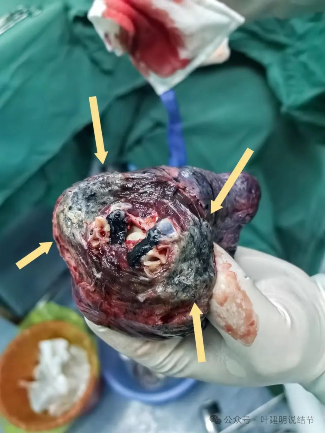 上叶病灶剖面观,明显恶性肿瘤的样子