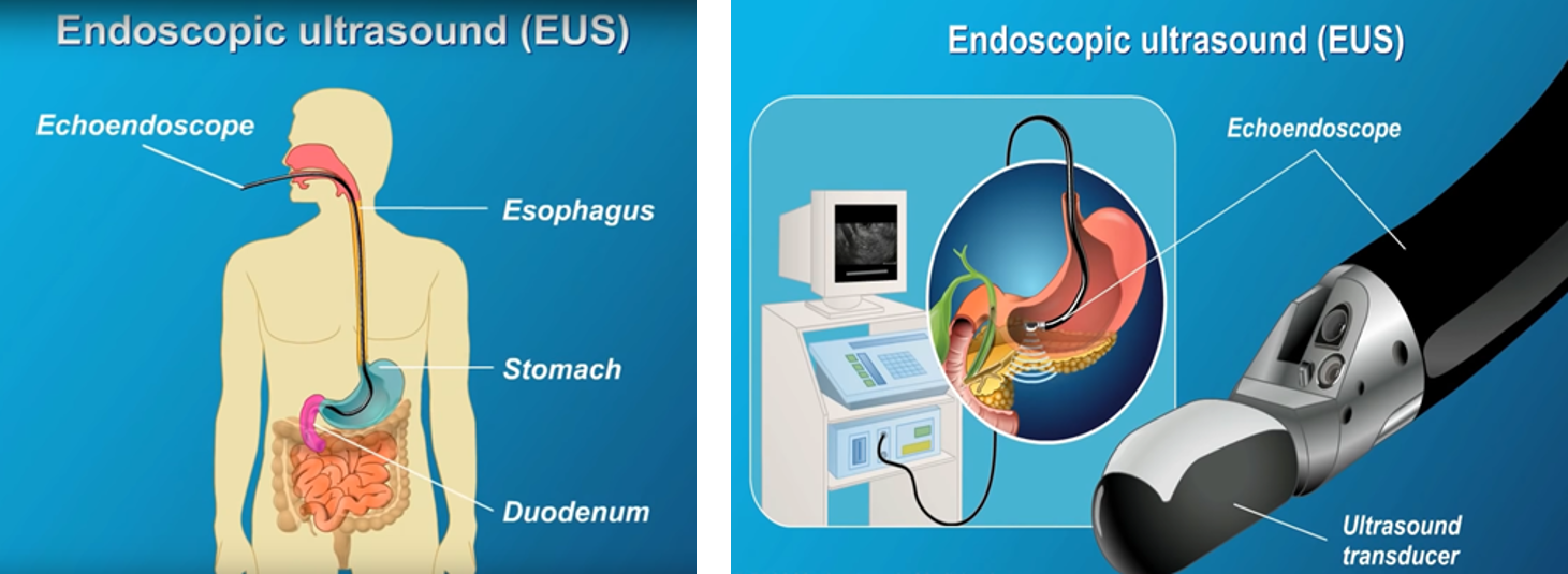 而超聲胃鏡就是在普通胃鏡前端加設高頻超聲探頭,以提供比胃鏡更為