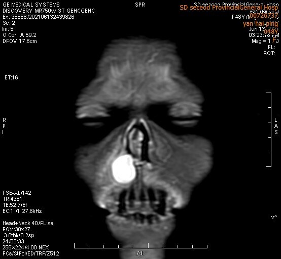 鼻前庭囊肿如何治疗 鼻前庭囊肿 好大夫在线