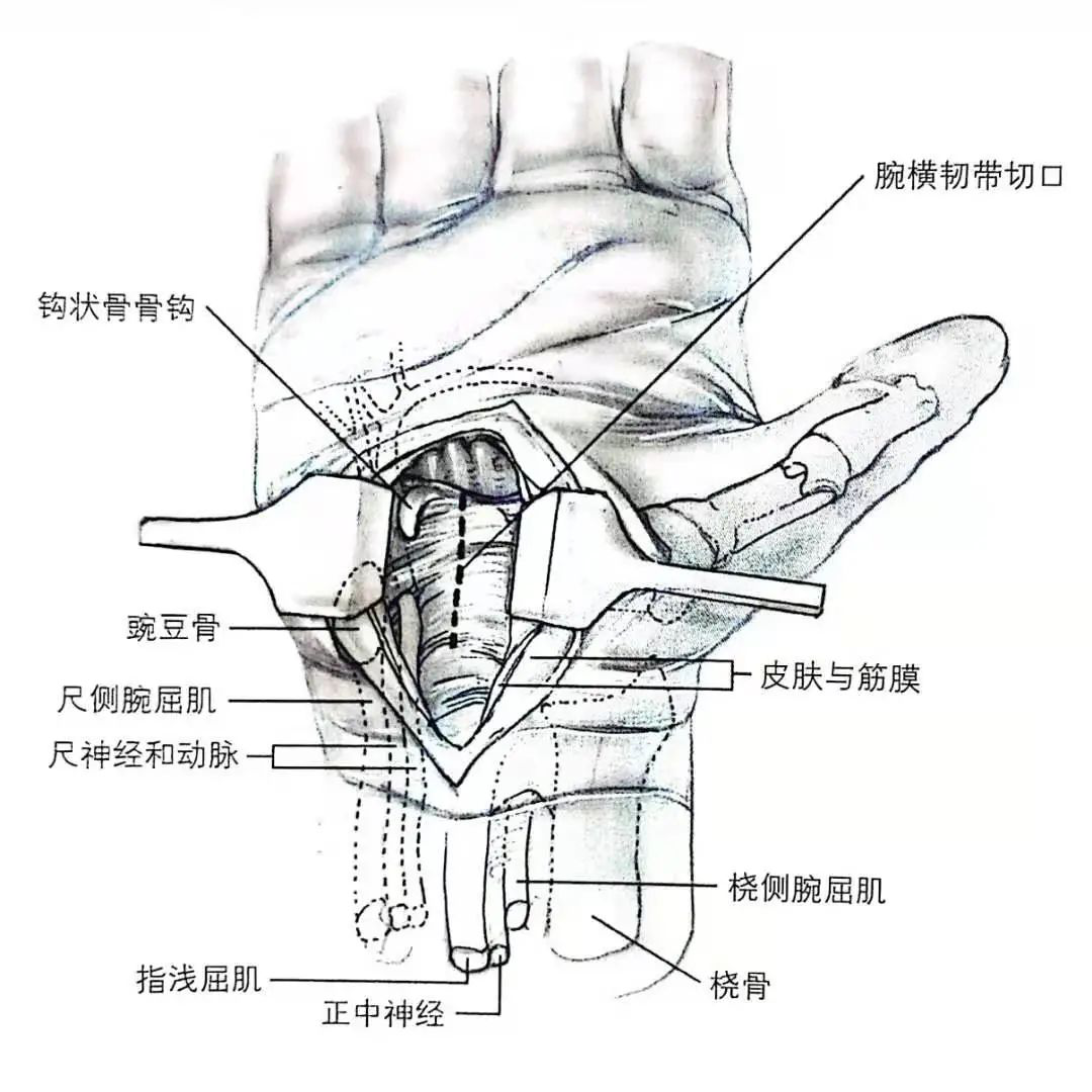 在正中神經的尺側進行操作,避免損傷在guyon 管內走行的尺神經,同時