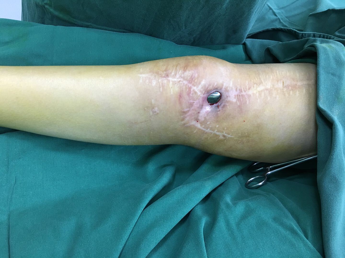 膝关节置换手术后感染