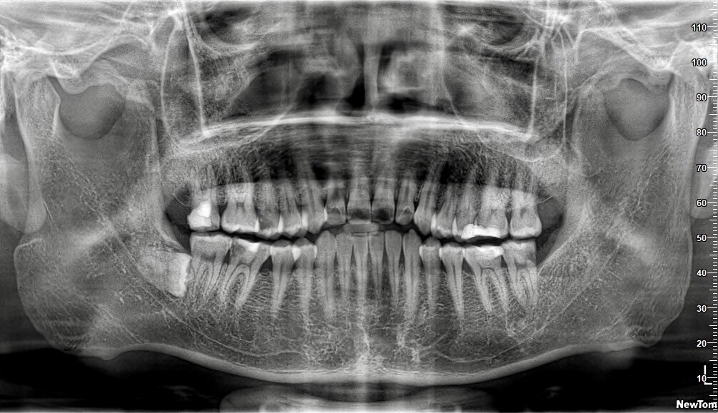 智齿离神经近怎么办? - 好大夫在线