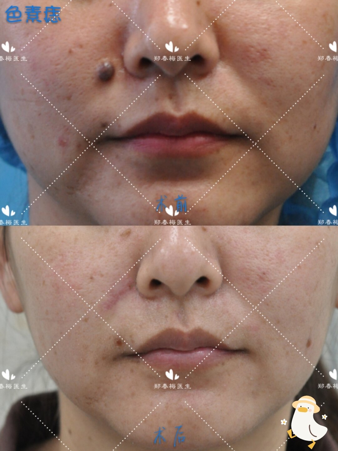 面部不同部位色素痣的切除与美容修复 - 好大夫在线