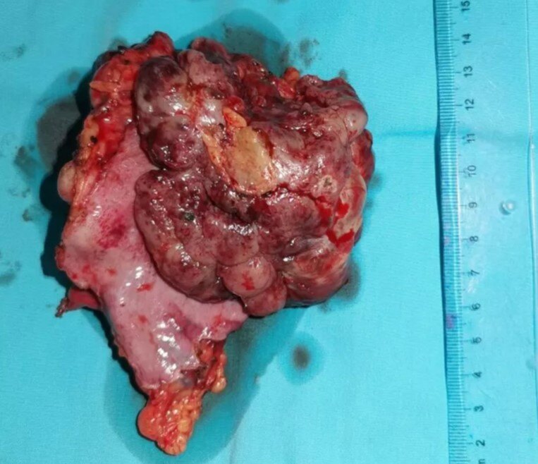 图2,切除的巨大侵袭性胸腺肿瘤,侵透心包