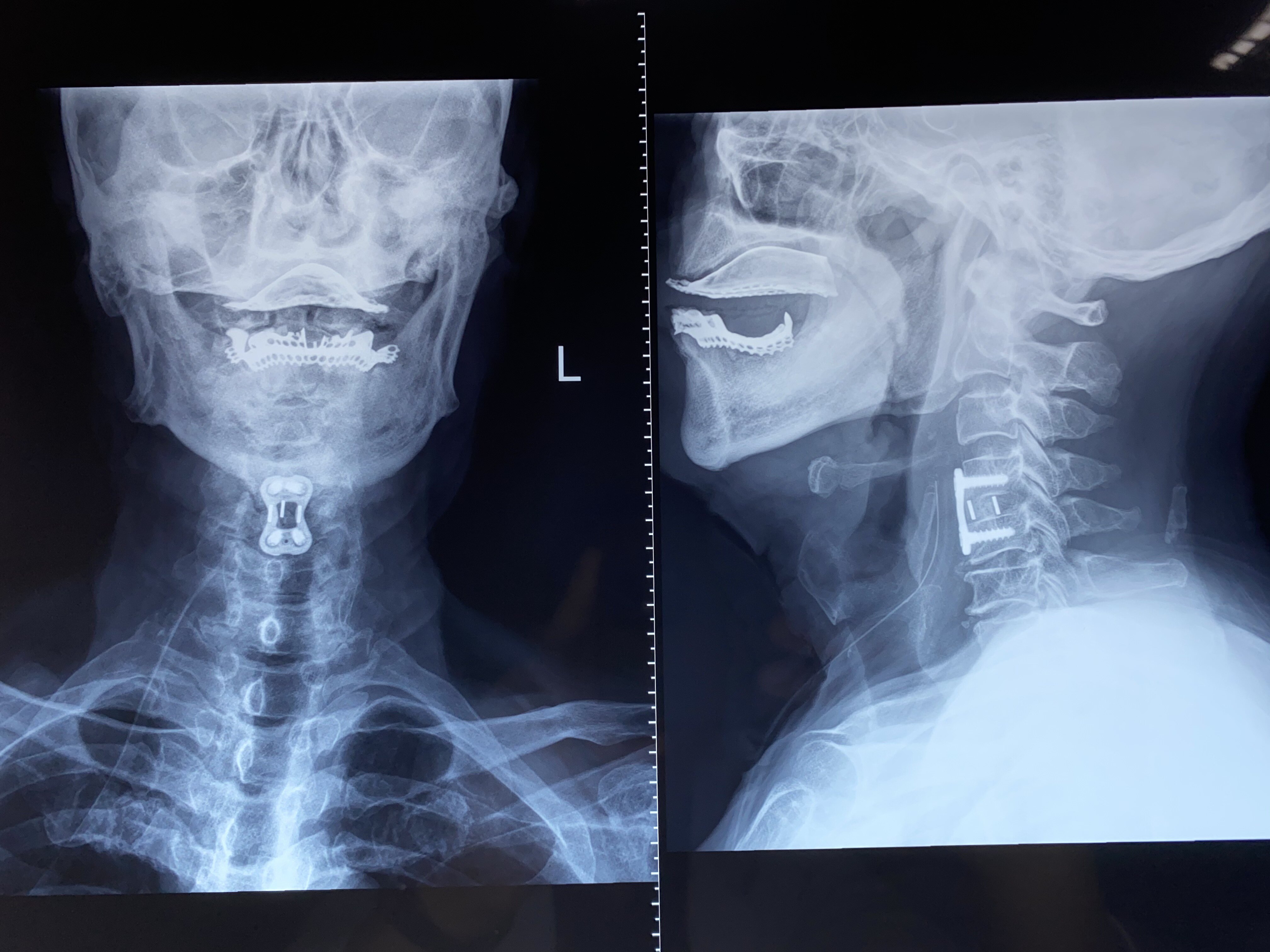术中取出的压迫脊髓的椎间盘及骨赘组织颈椎侧位片示:颈椎生理曲度