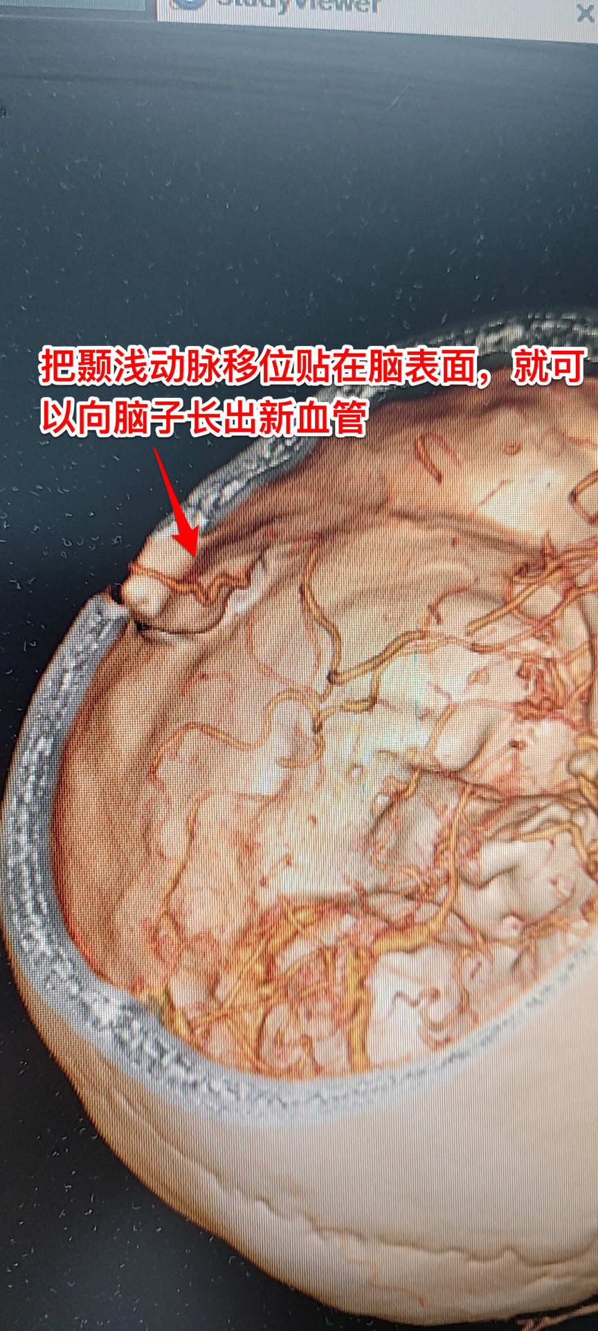 烟雾病是什么病