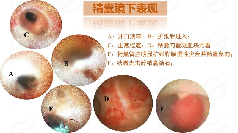 图：精囊镜下表现.jpg