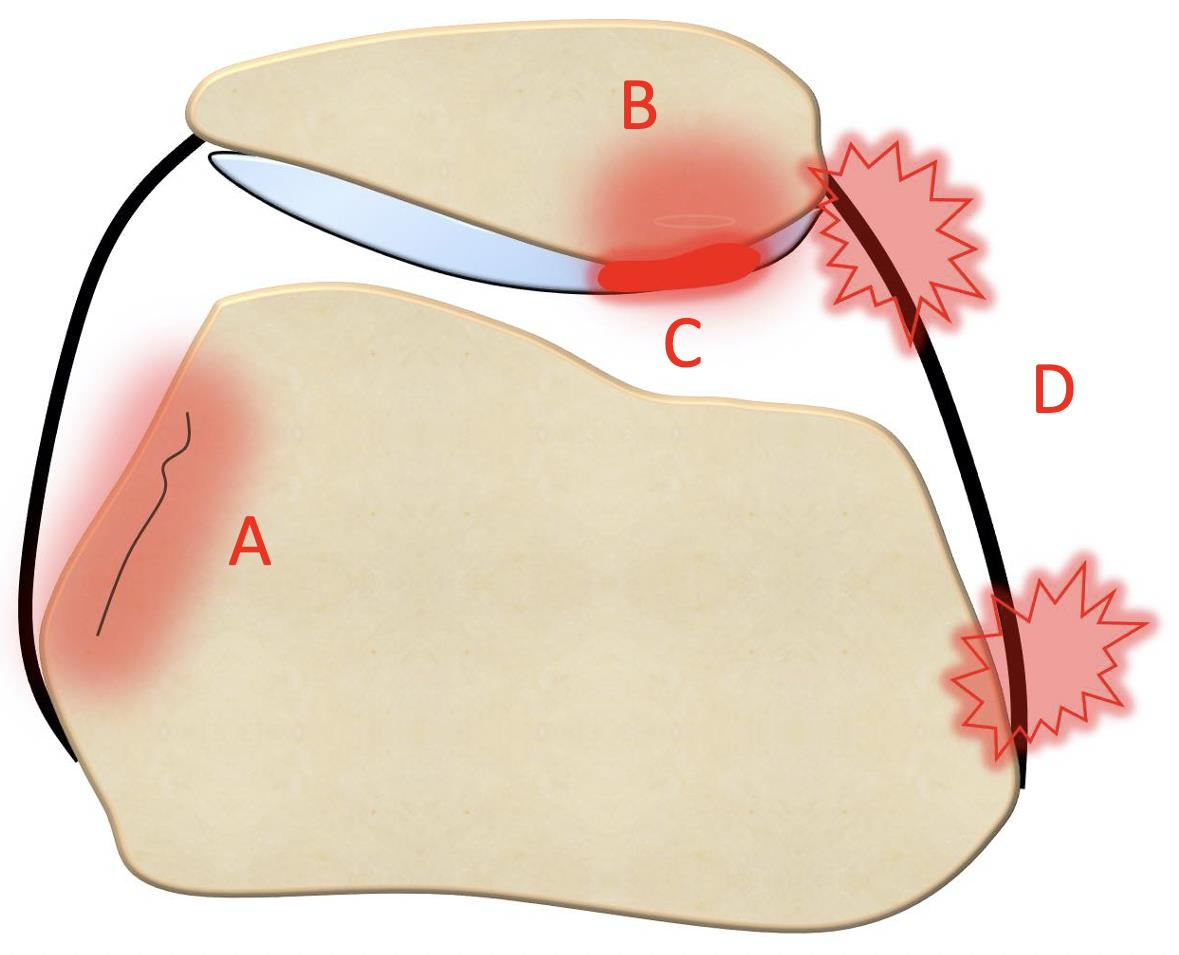 髌骨不稳定的诊断与治疗
