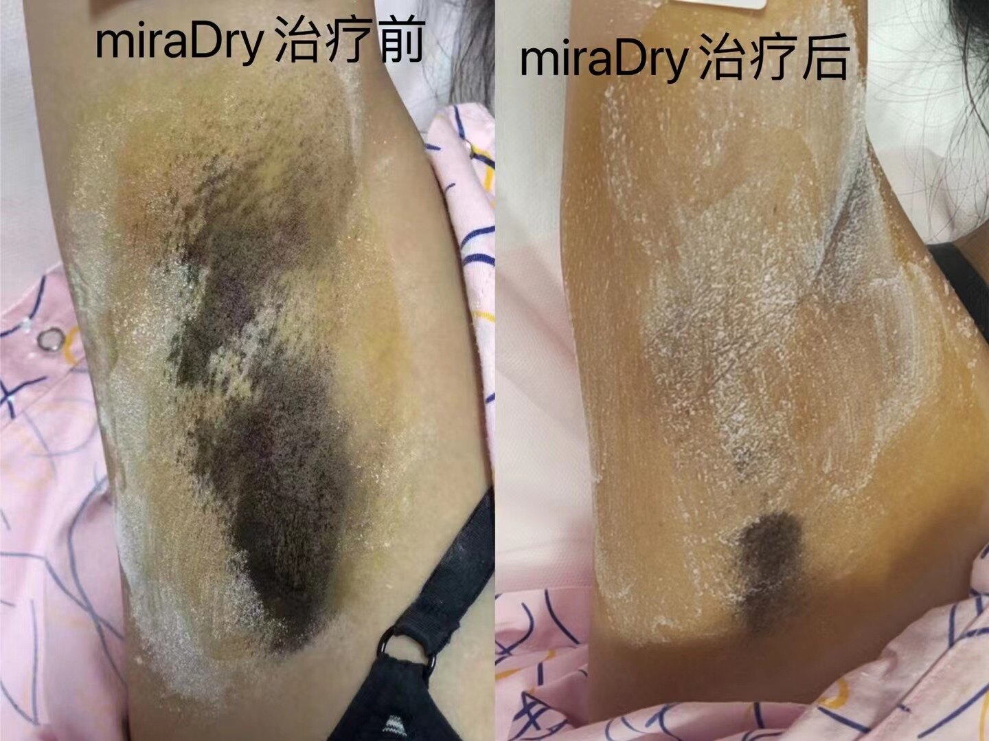 微波治療腋臭腋下多汗運動碘掉粉實驗治療前後對比