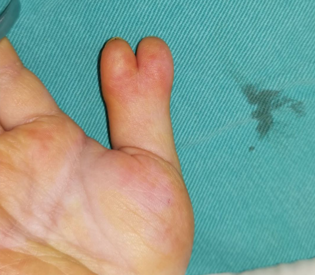 这是多指还是并指?什么时候做手术比较好?