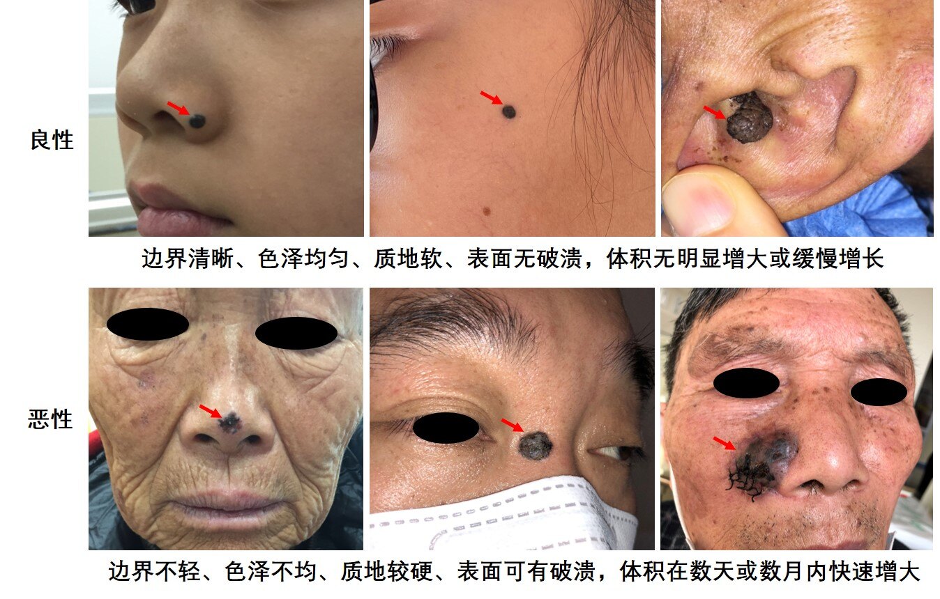 有痣青年关于"痣"你知道多少?_痣 - 好大夫在线