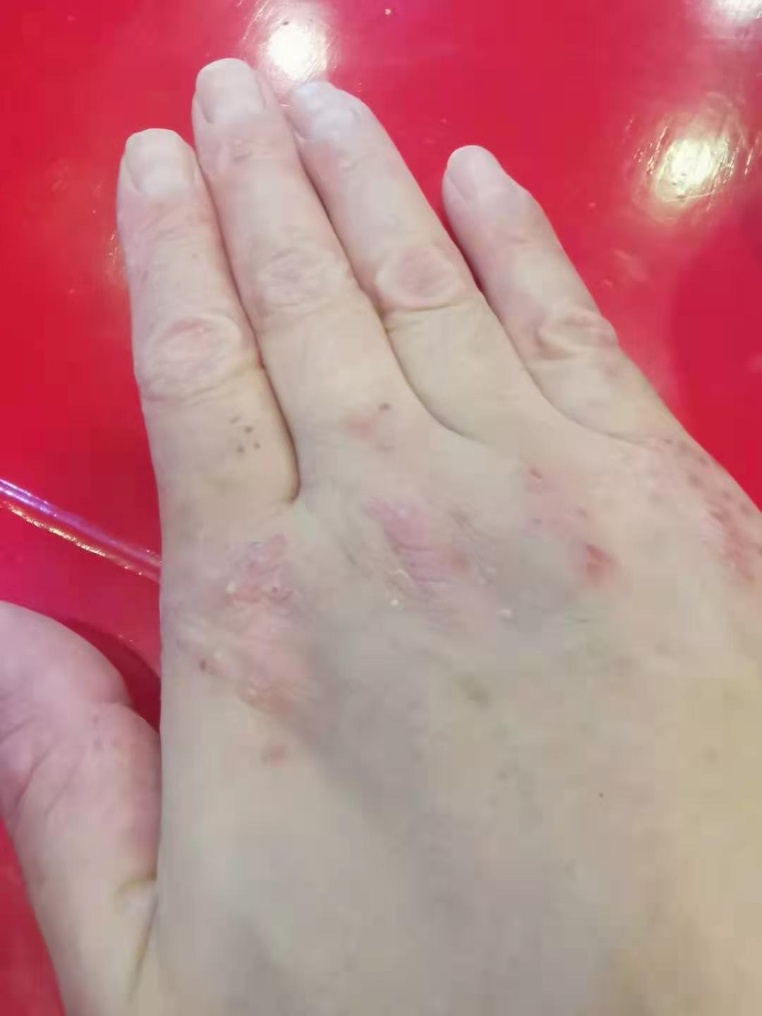 中医治疗手部顽固性湿疹 - 好大夫在线