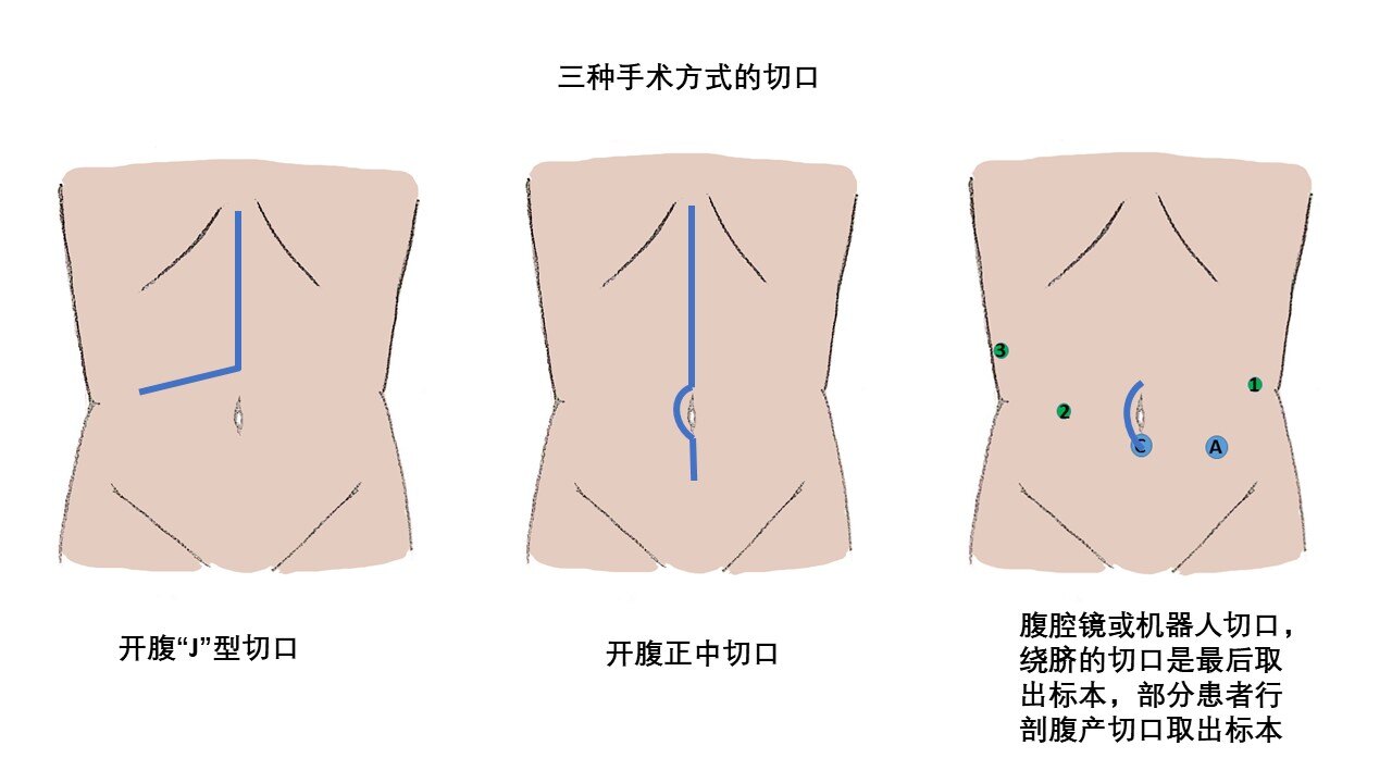 妇科腹腔镜切口位置图片