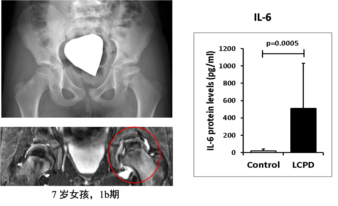 perthes 病科普系列之三