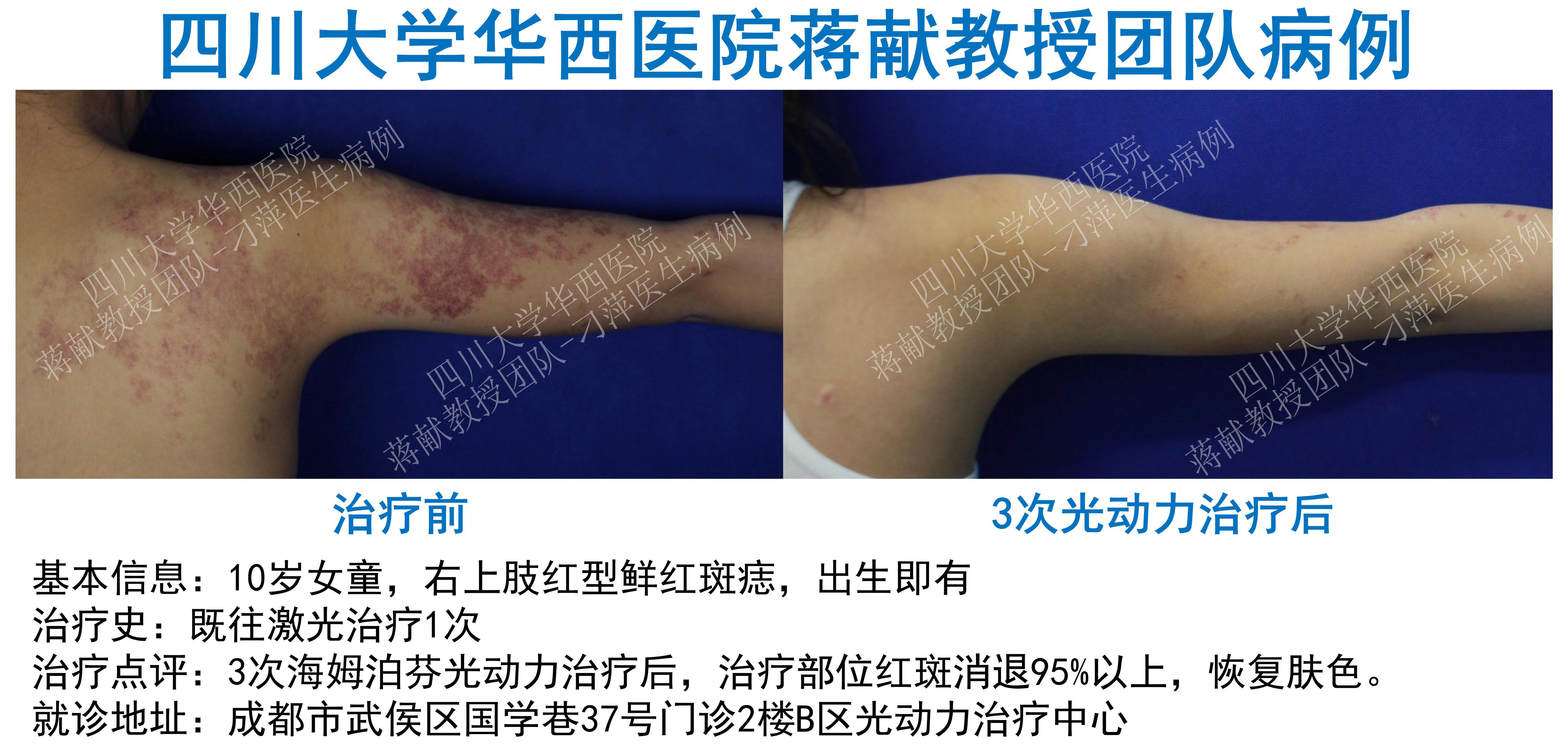 四肢鲜红斑痣光动力治疗疗效分享(高清对比图) - 好大夫在线