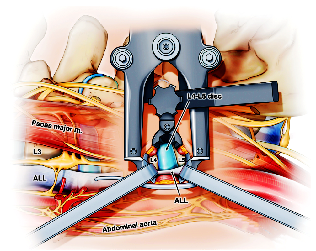 "俯卧位"llif手术:cadaver 可行性研究及早期临床经验 - 好大夫在线