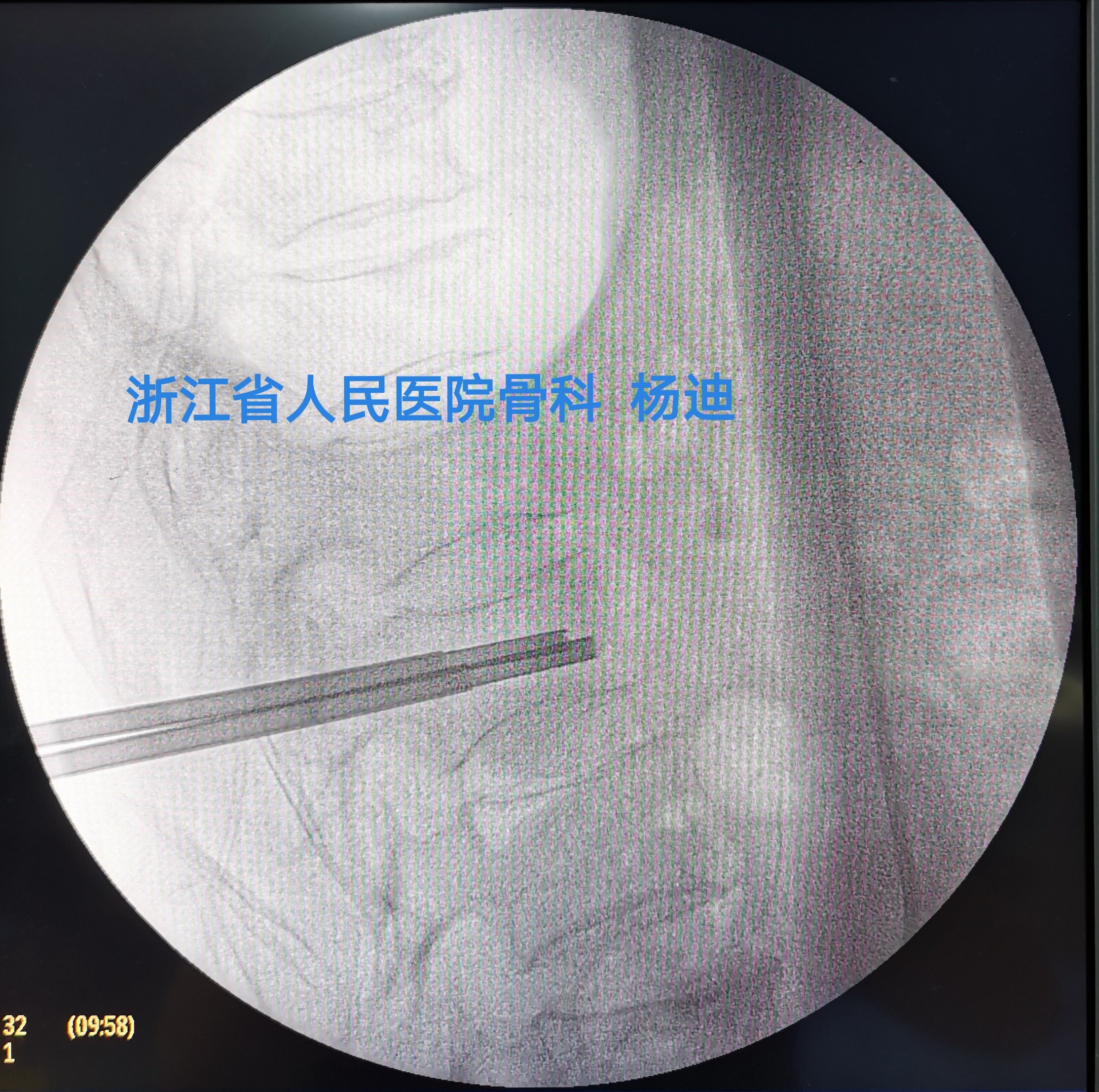 微創骨水泥pkp治療老年脊柱骨質疏鬆性骨折