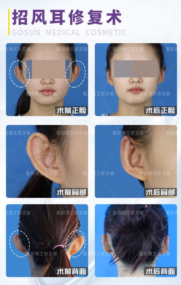 余文林博士|招风耳修复矫正手术案例耳廓畸形,分为结构畸形(胚胎期