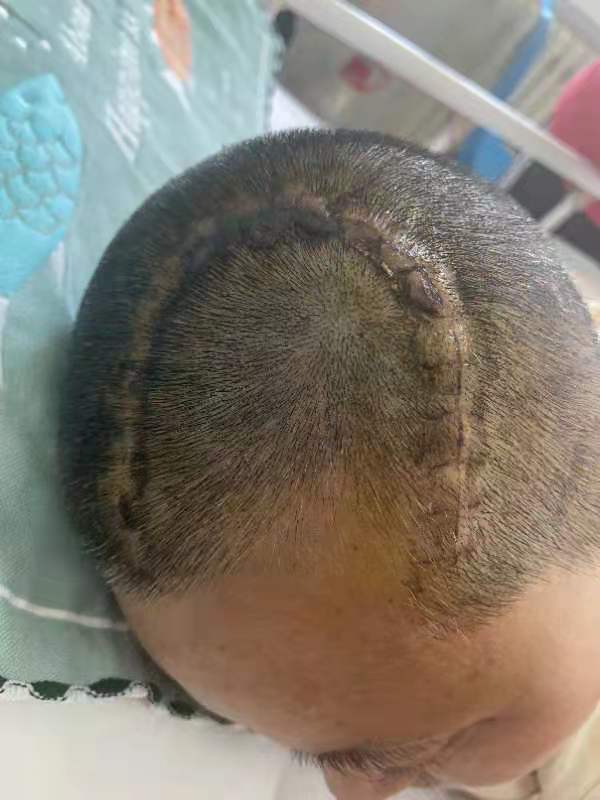 左侧大面积脑出血,失语,怎么快速让她会讲话走路?
