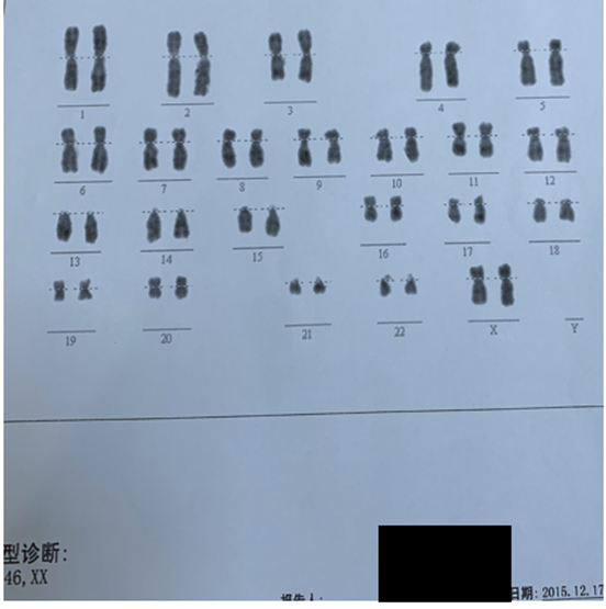 染色體檢查漏診病例(一) - 好大夫在線