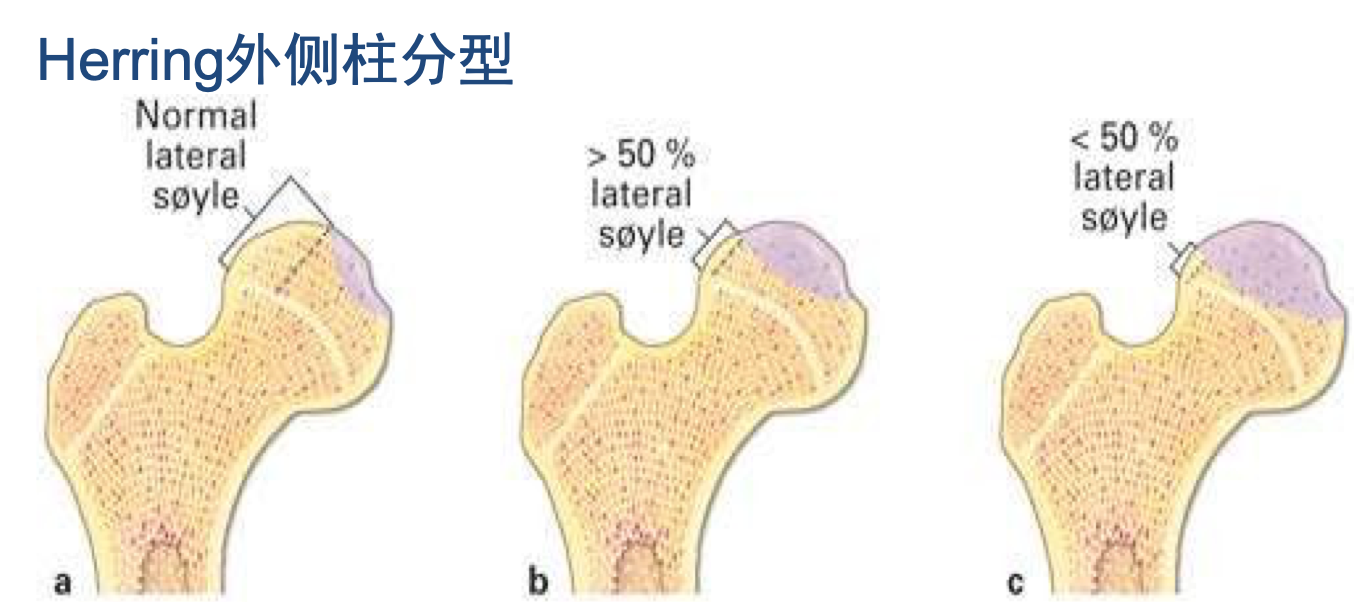 perthes 病科普系列之六:perthes病治疗结果能预测吗?