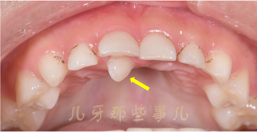 多生牙知多少 