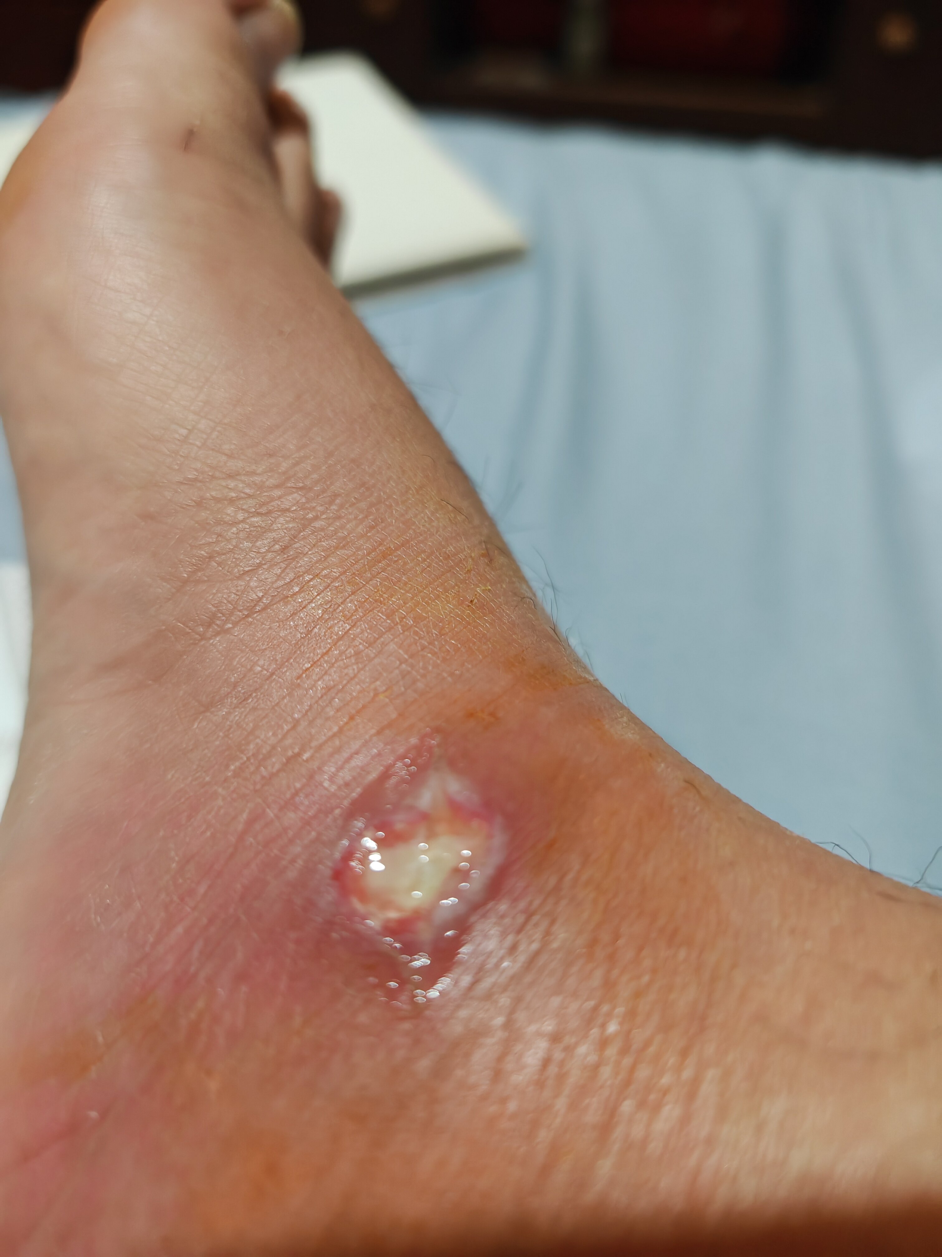 皮肤软组织感染清创治疗原则