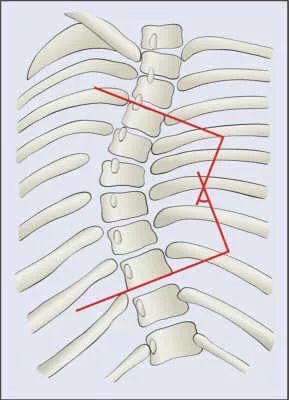 侧弯最倾斜的两个椎体间的交角cobb角的度数就是我们常说的侧弯度数