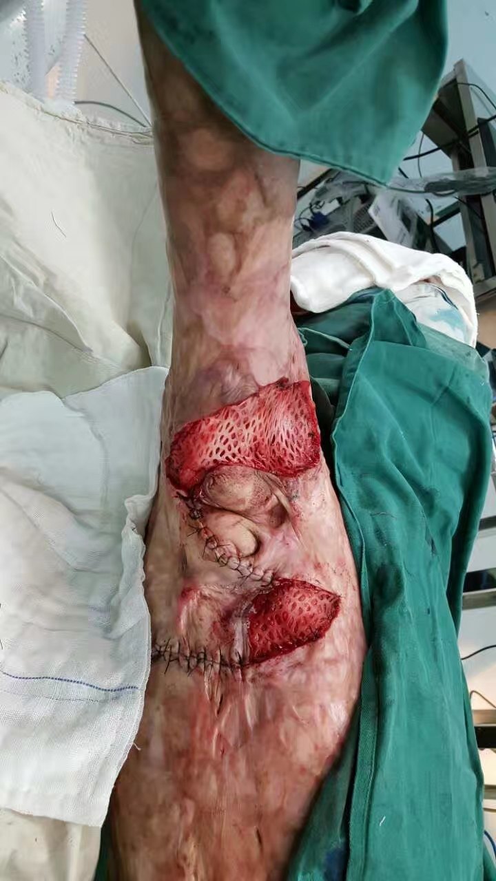 腋窝疤痕畸形手术前后对比 - 好大夫在线