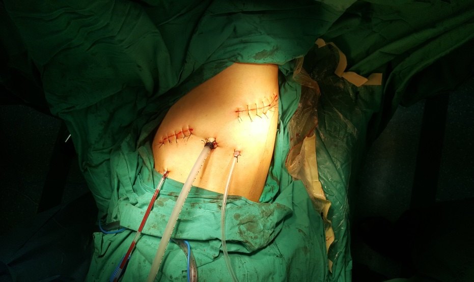 肋骨融合手术图片