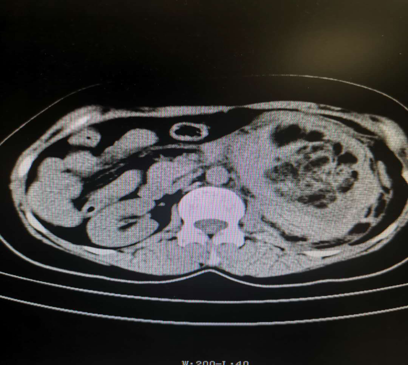 肾脏错构瘤破裂出血介入治疗 肾错构瘤 症状 介入治疗