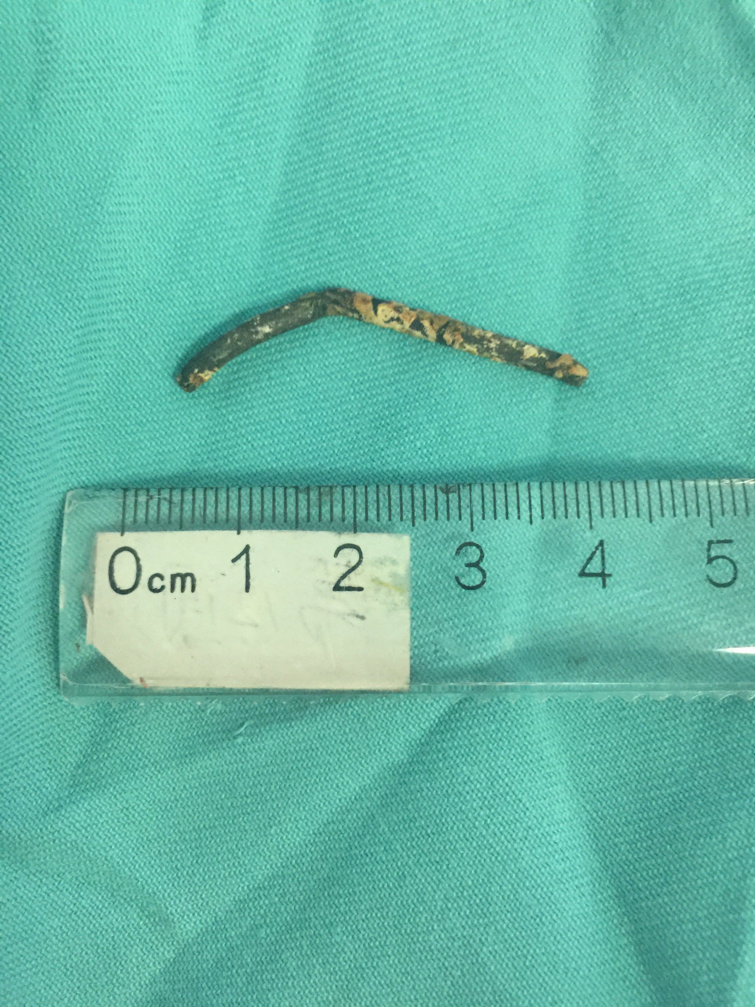 开颅取出从眼眶飞入颅内的钢钉 - 好大夫在线