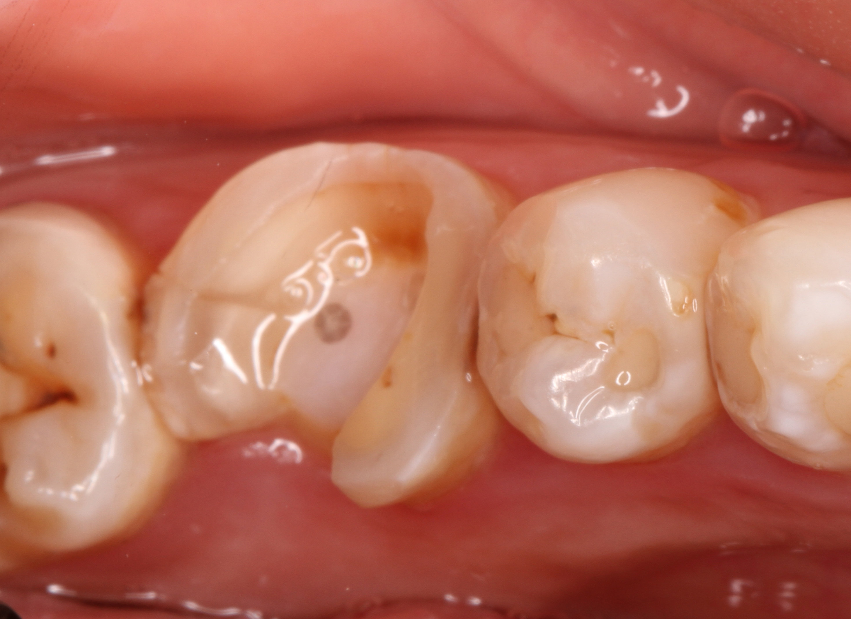 下颌磨牙根管治疗后高嵌体修复一例 
