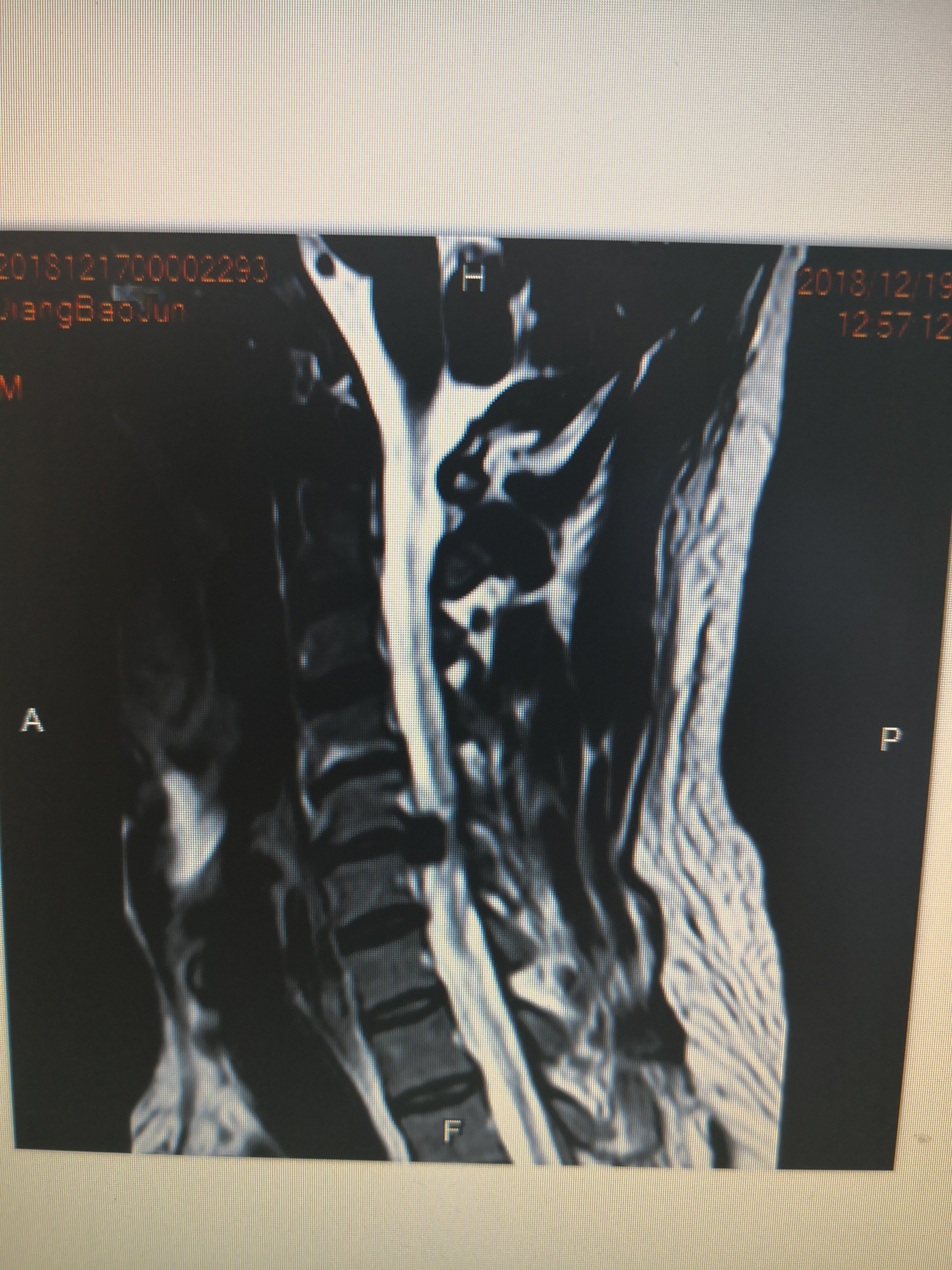 颈椎病片子图片