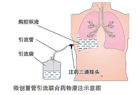 双肺感染.双侧胸腔积液肺转移宫颈癌能开盐酸吗啡缓释片吗