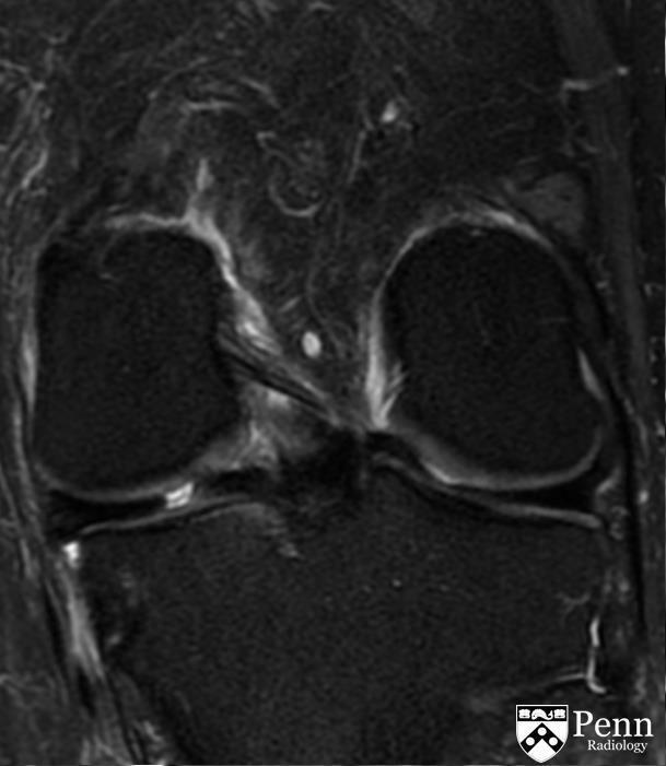 案例教学 膝关节半月板撕裂的mri诊断