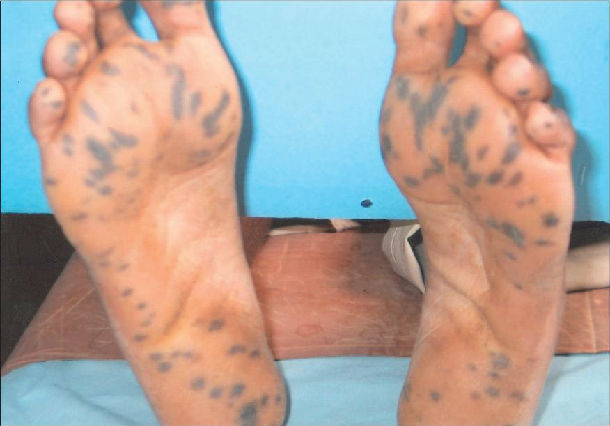 关于结直肠息肉的10个问题 - 好大夫在线