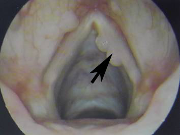 咽部乳头瘤图片