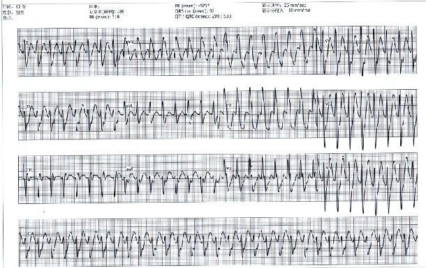 左后分支型室速----最容易被误诊为室上速的室速_室性心动过速_疾病