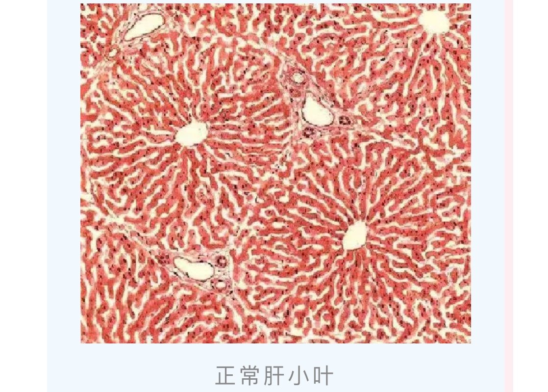 肝硬化组织切片图片