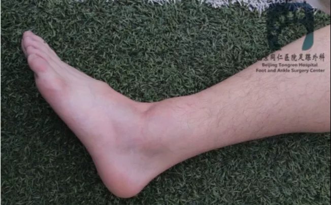 当心踝关节外侧韧带损伤!