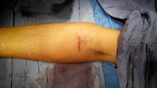 浅谈血液透析通路系列之一:肘部自体动静脉内瘘 - 好大夫在线